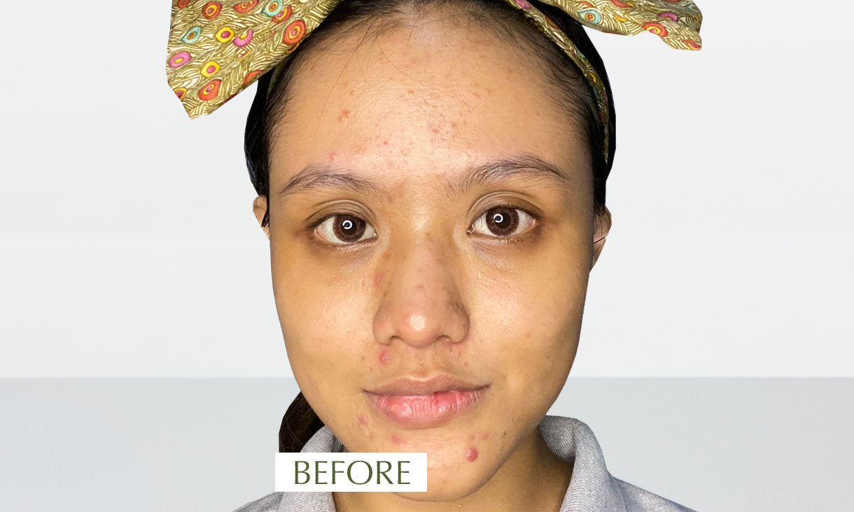 Photo showing a woman with irritated, troubled and uneven skin before using SUDTANA’s all-natural skincare products.